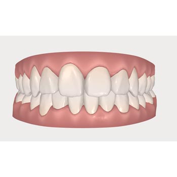 矯正後の歯並びのイメージ