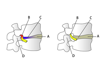 椎間板ヘルニアで痛む椎骨 / 痛みのない健康な椎骨と椎間板