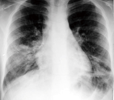 マイコプラズマ菌に感染した肺